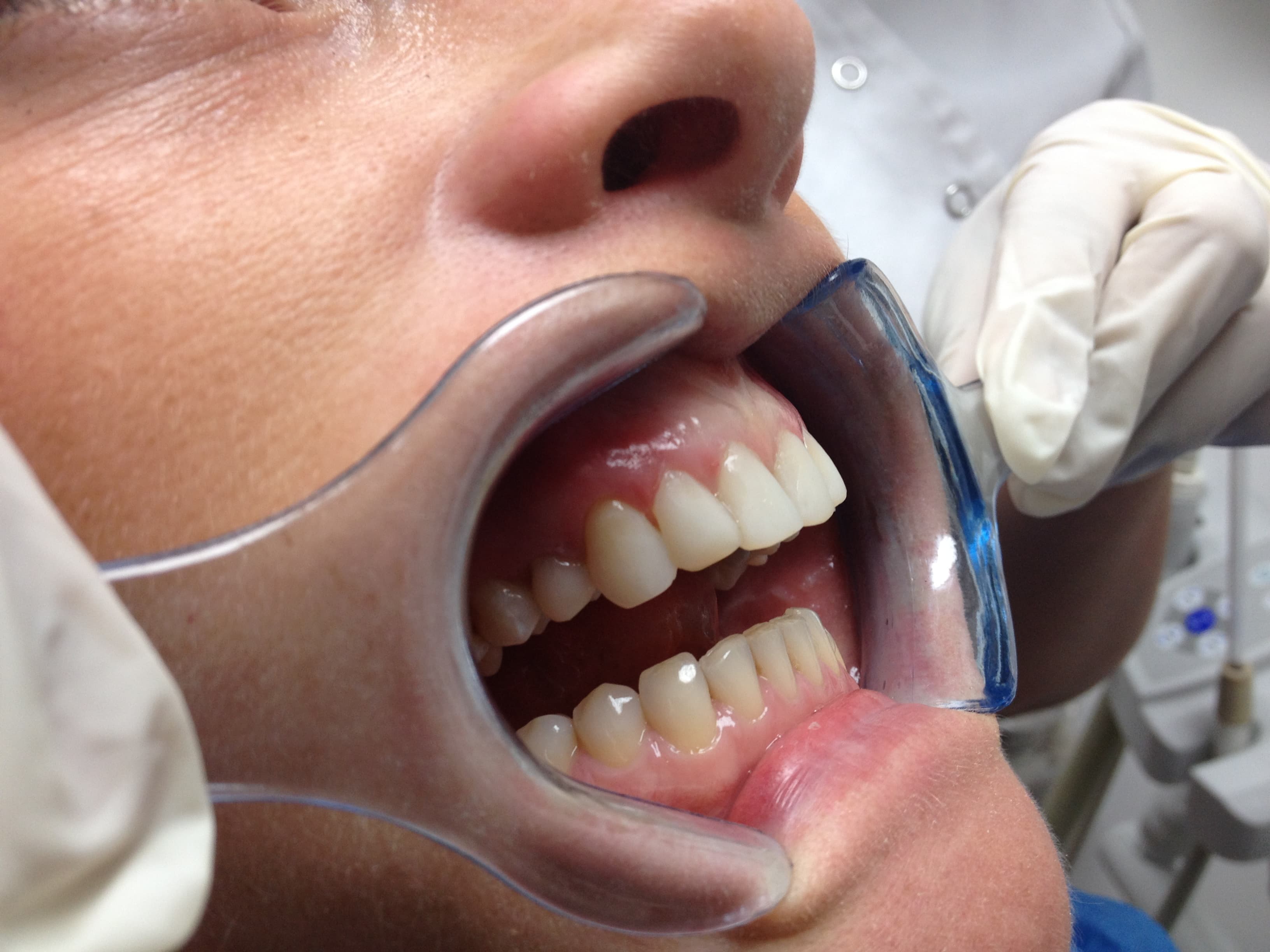 Composite Bonding Enhancement — after