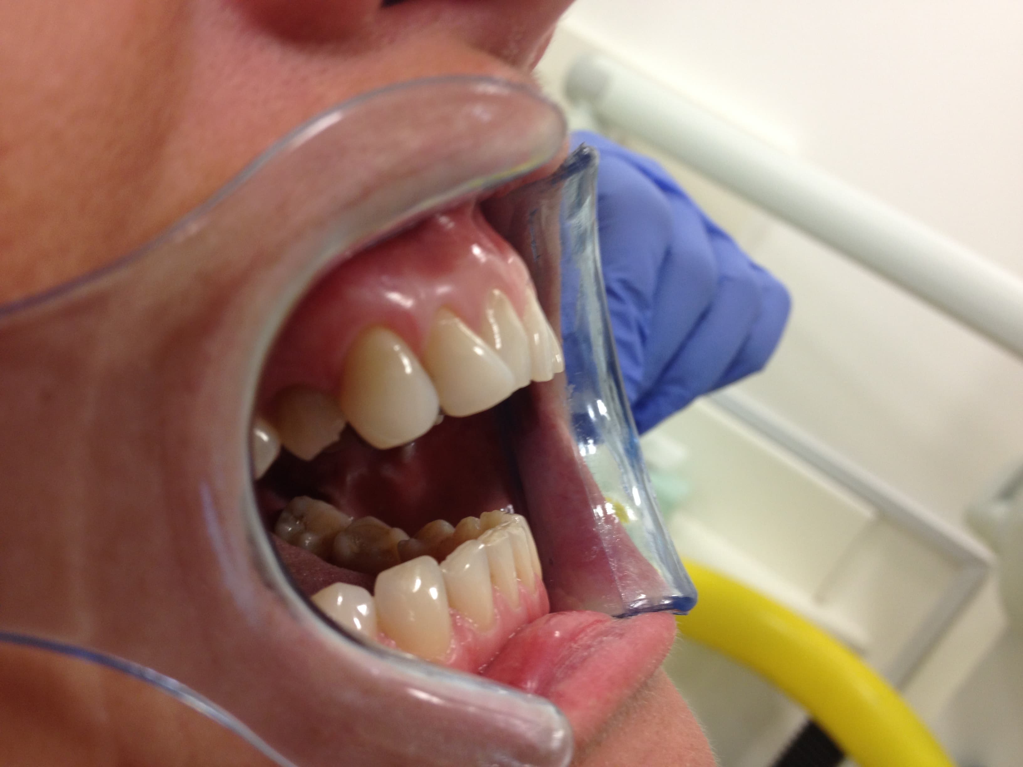 Composite Bonding Enhancement — before