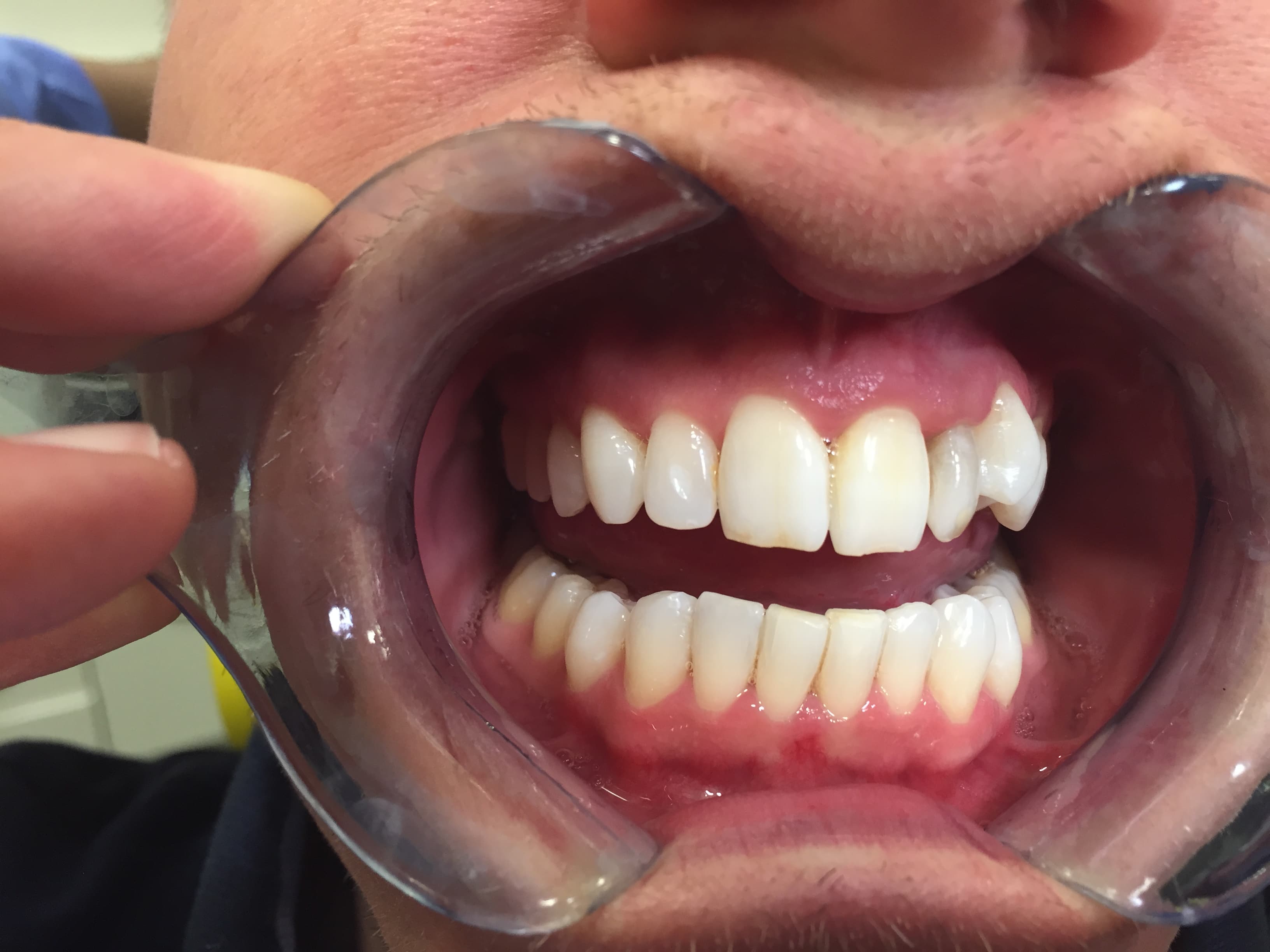 After In-Surgery Teeth Whitening