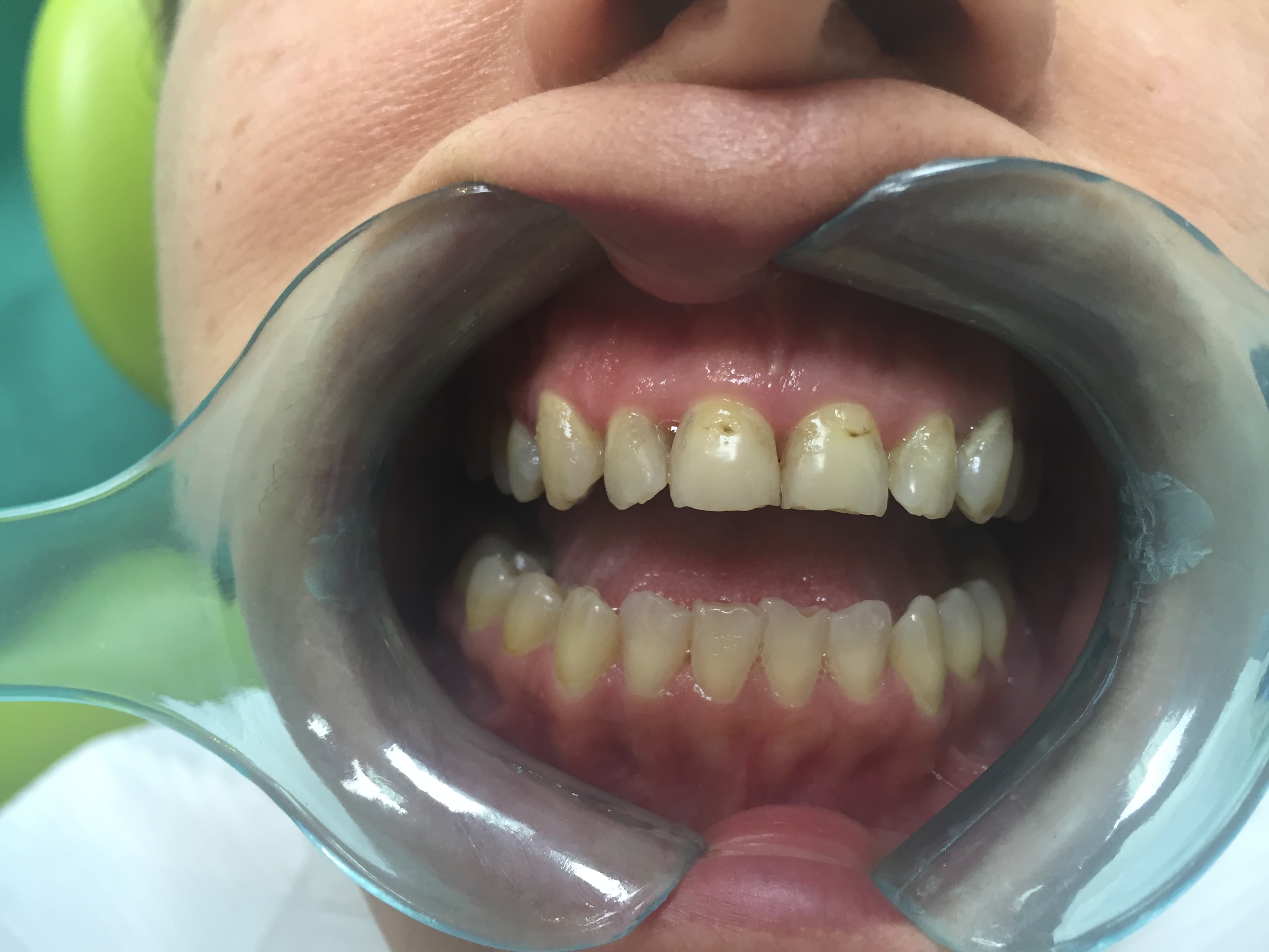 Before — Discoloured & Chipped Front Teeth