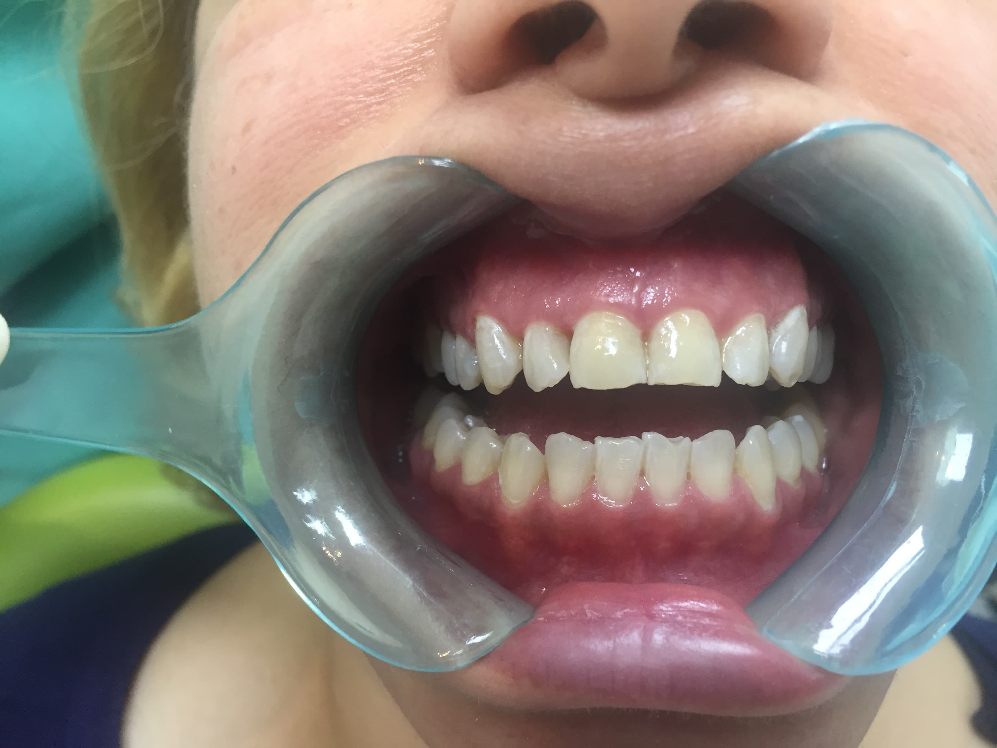 After — Discoloured & Chipped Front Teeth