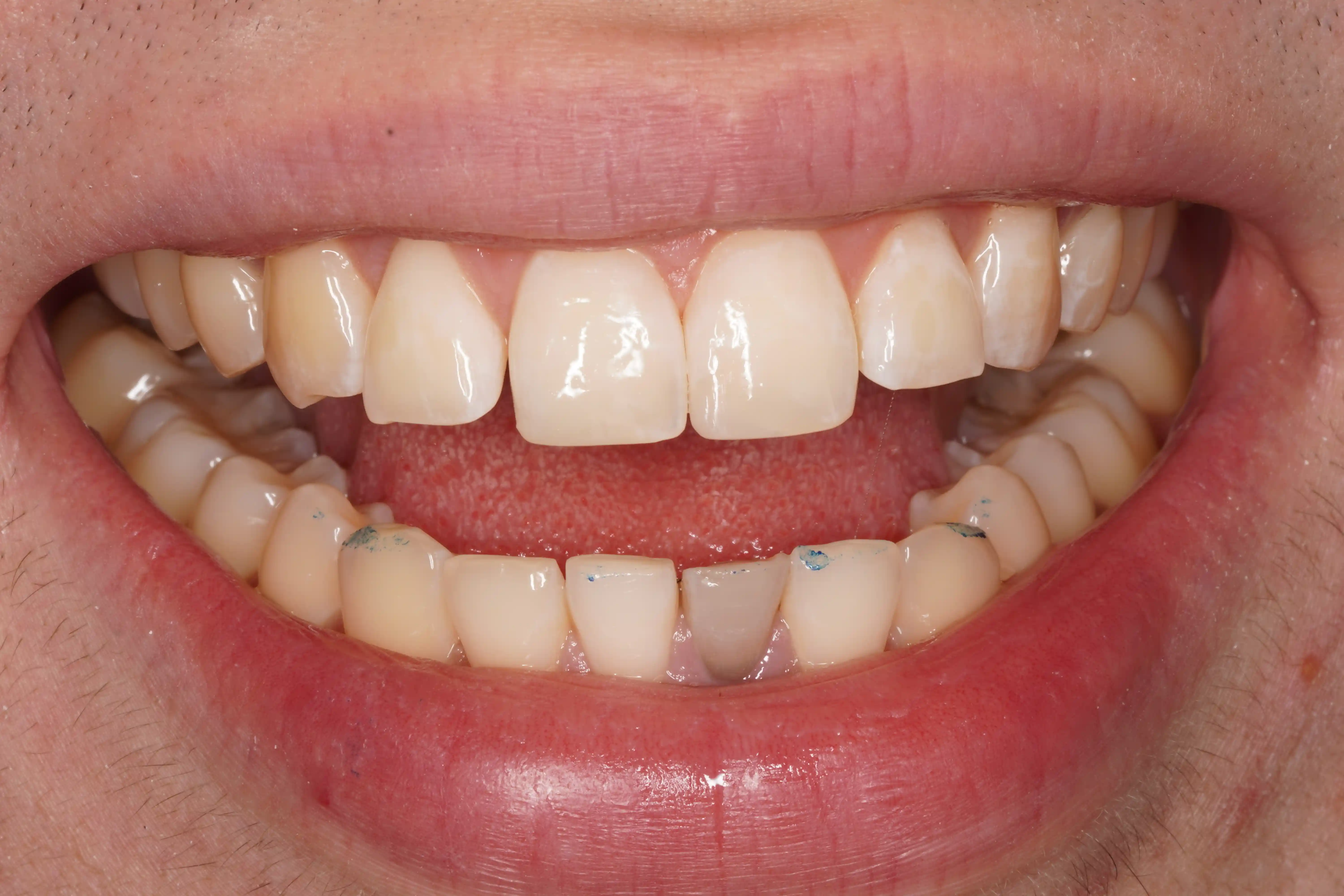 After Chipped Front Tooth — Seamless Repair