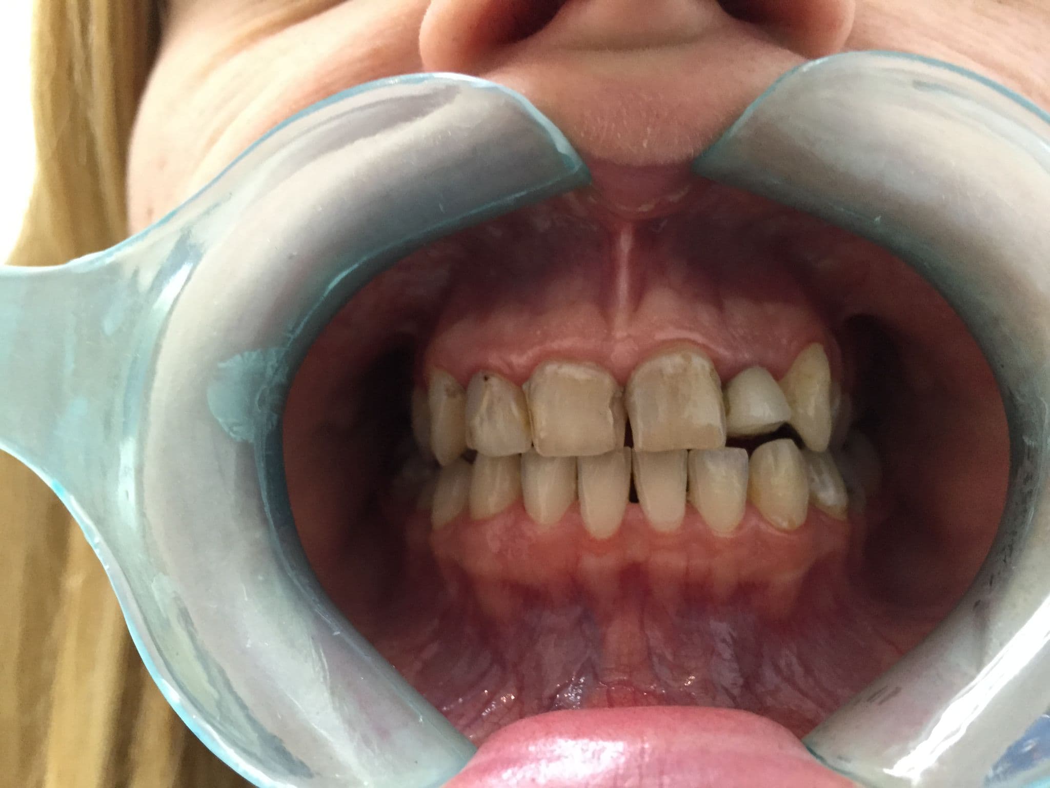 Beautiful Smile with Whitening & Veneers — before