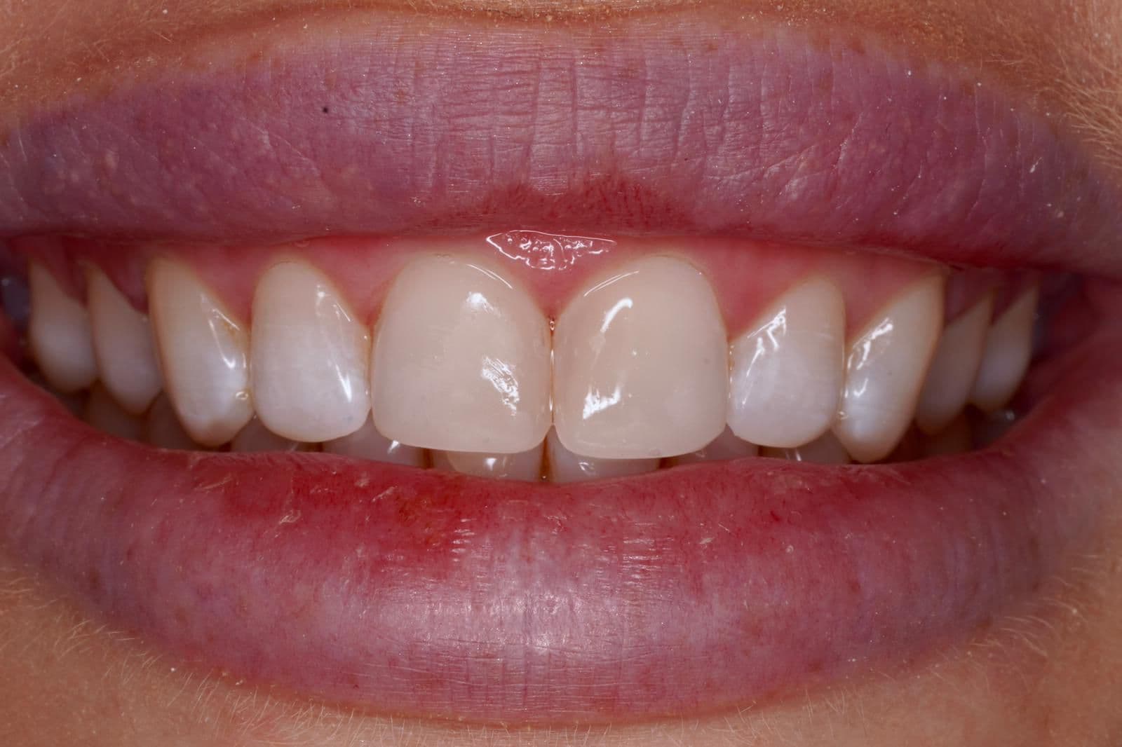 After composite bonding — chipped maxillary incisors repaired at Dental Clinic London