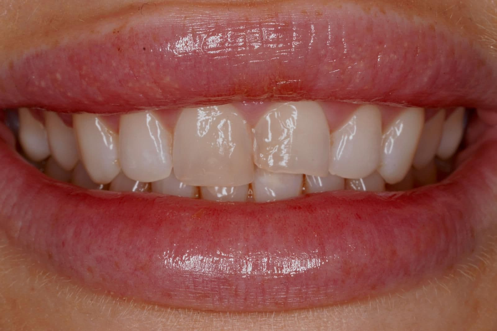 Before composite bonding — chipped maxillary incisors at Dental Clinic London