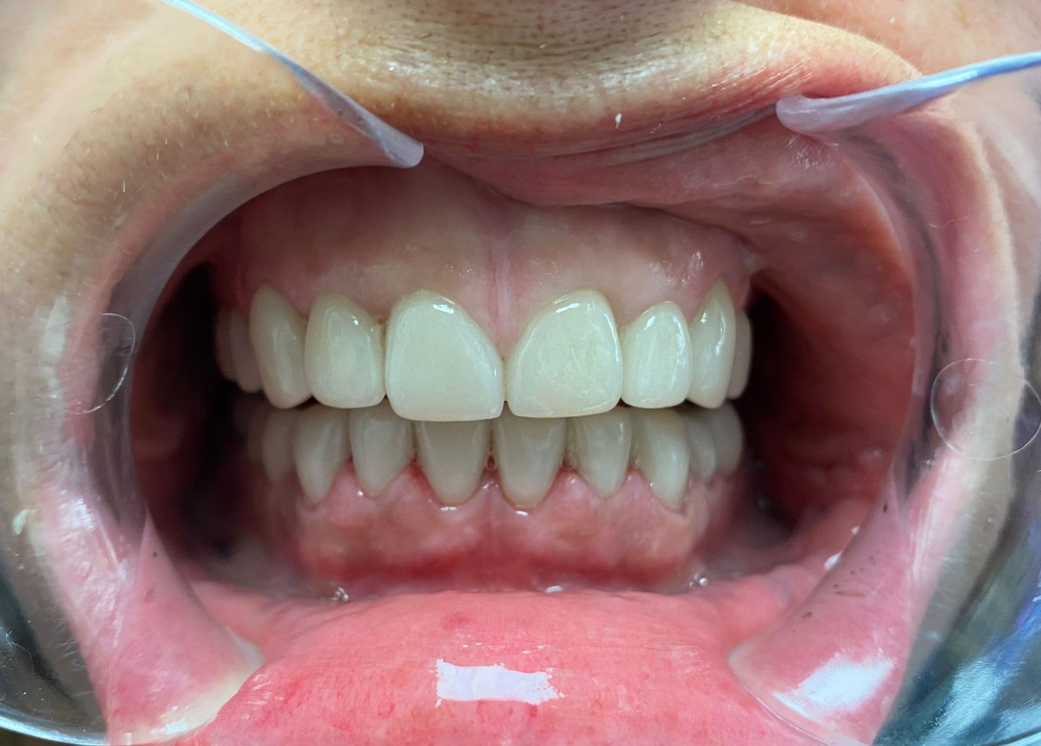 Dental crowns at Dental Clinic London — natural-looking ceramic restorations