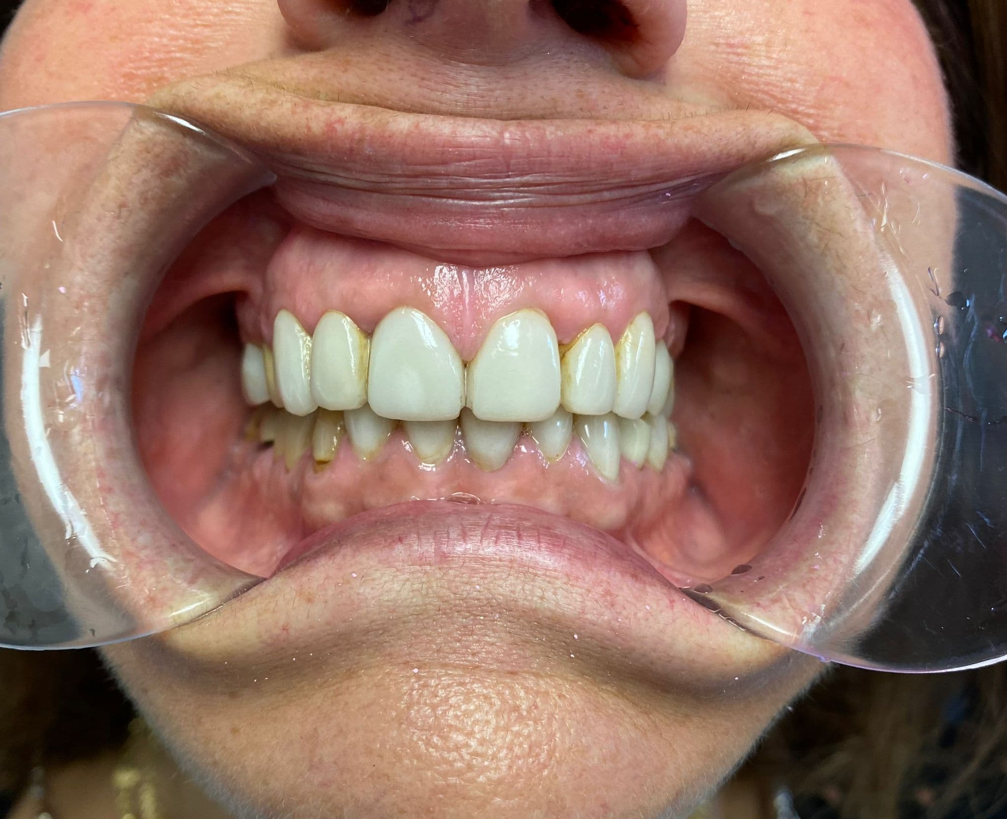 Full Smile Rejuvenation — Veneers & Crowns — before