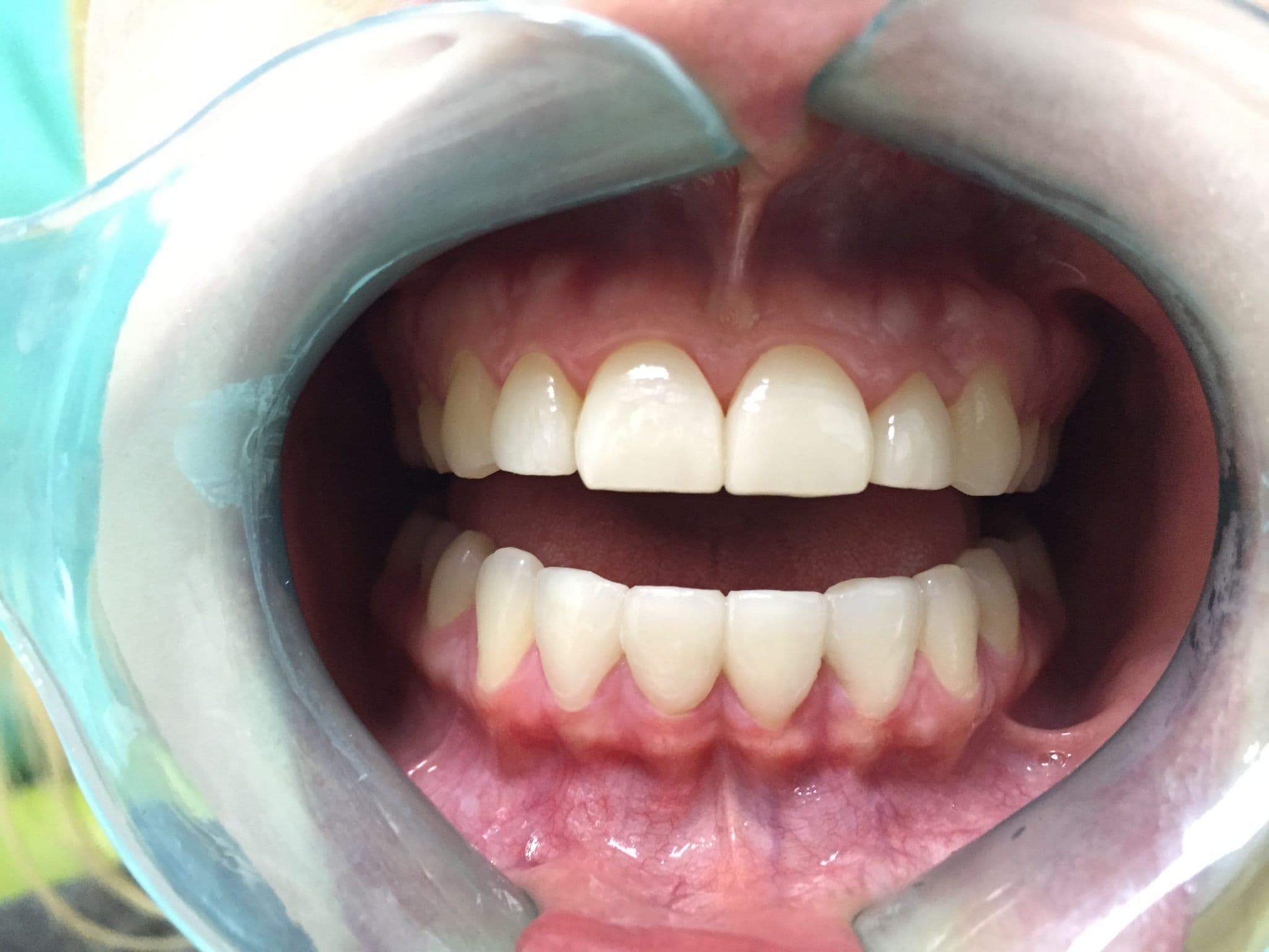 Full Smile Transformation — after