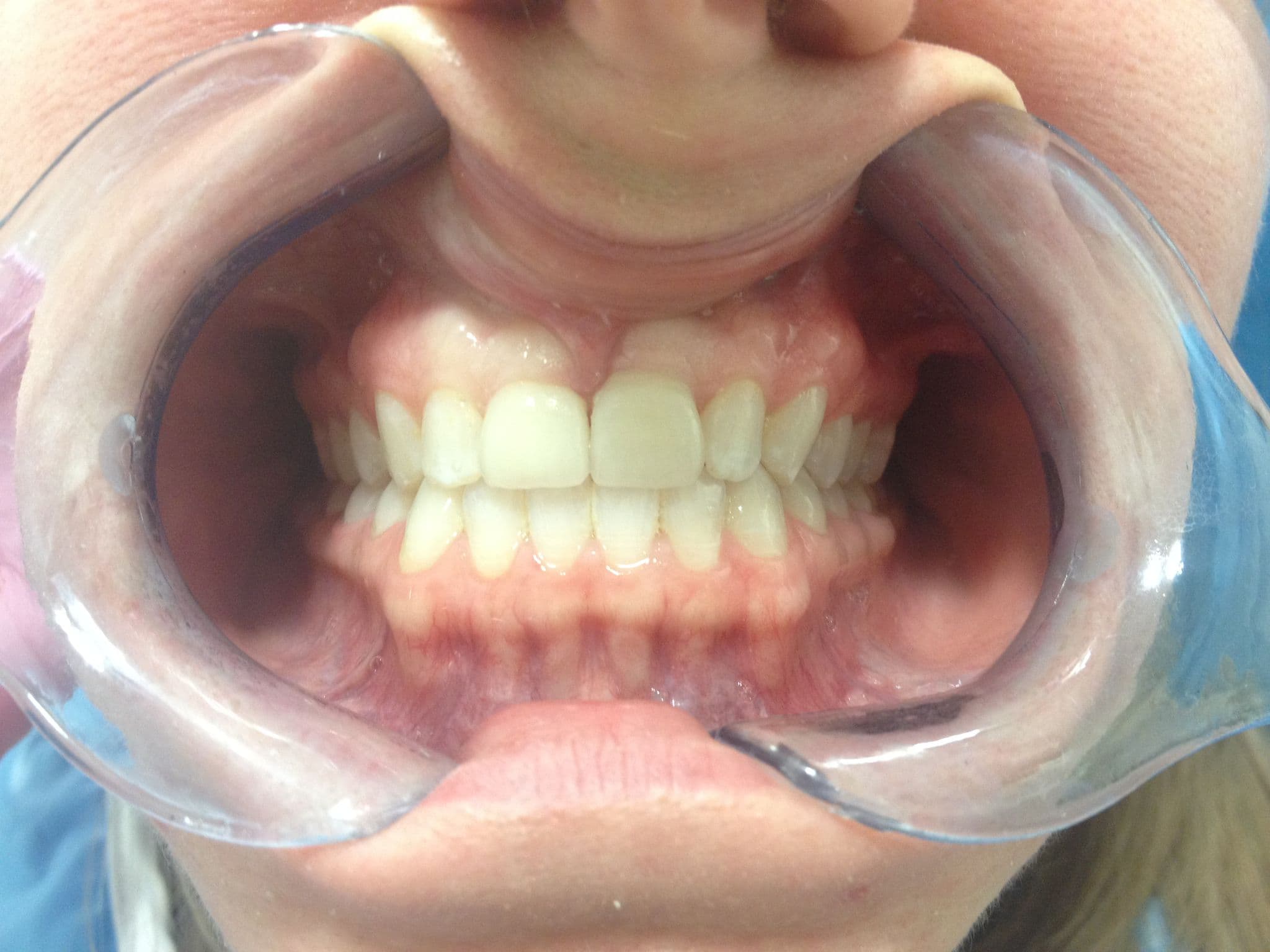 Long-Lasting Porcelain Restorations — after