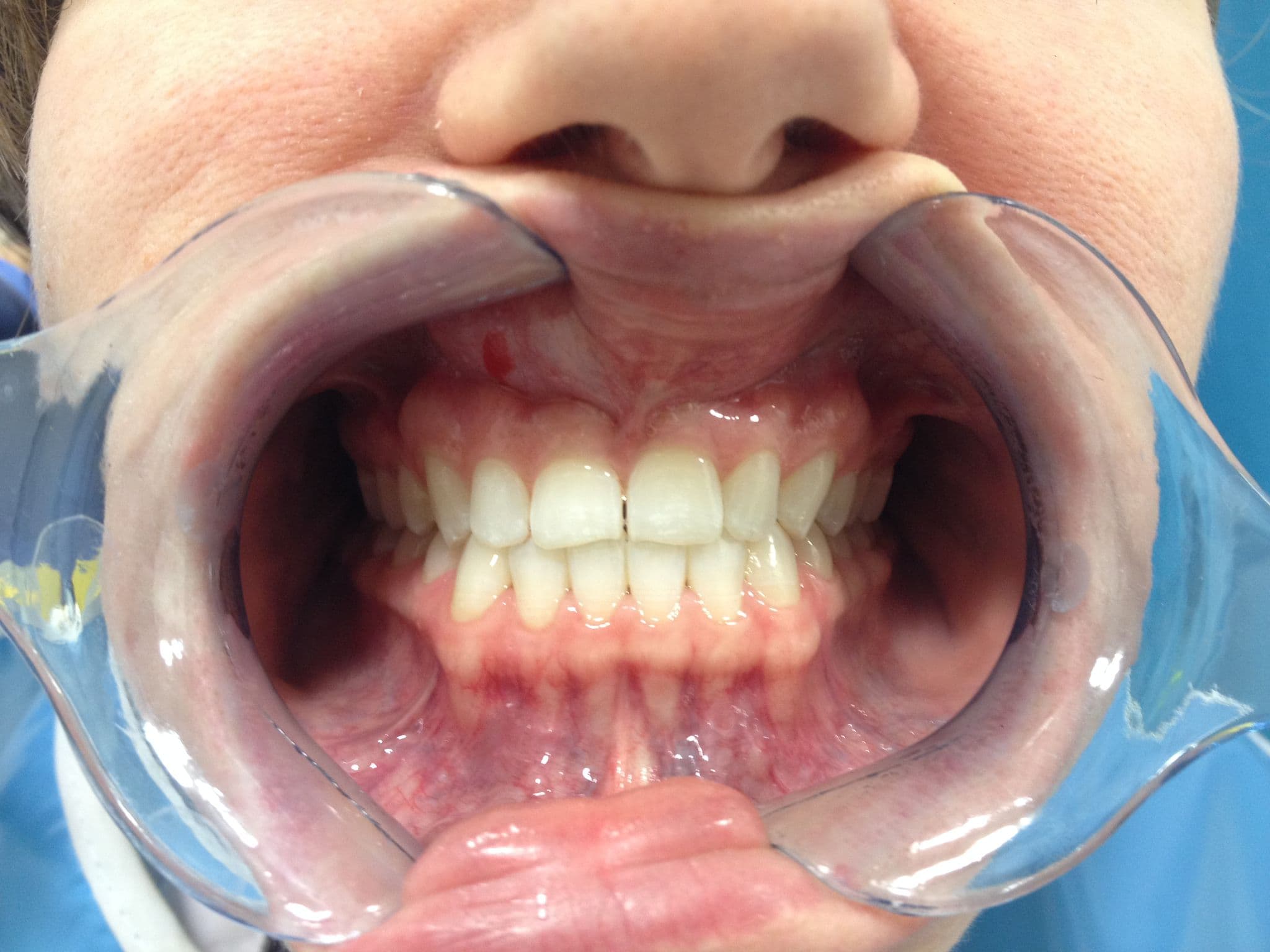 Long-Lasting Porcelain Restorations — before