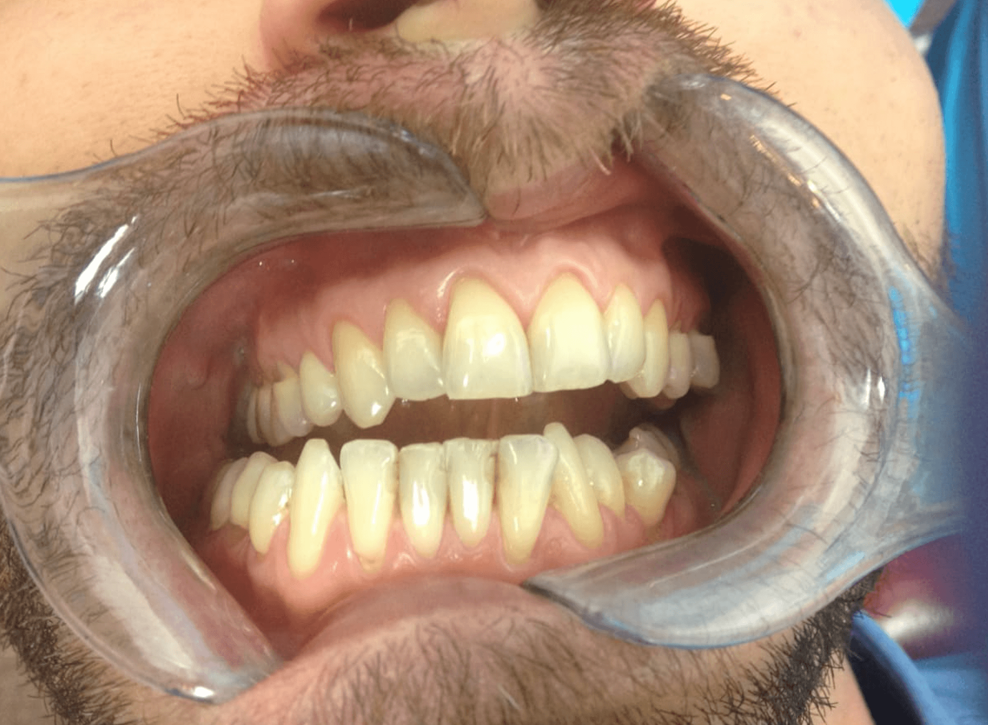 Before Home Teeth Whitening