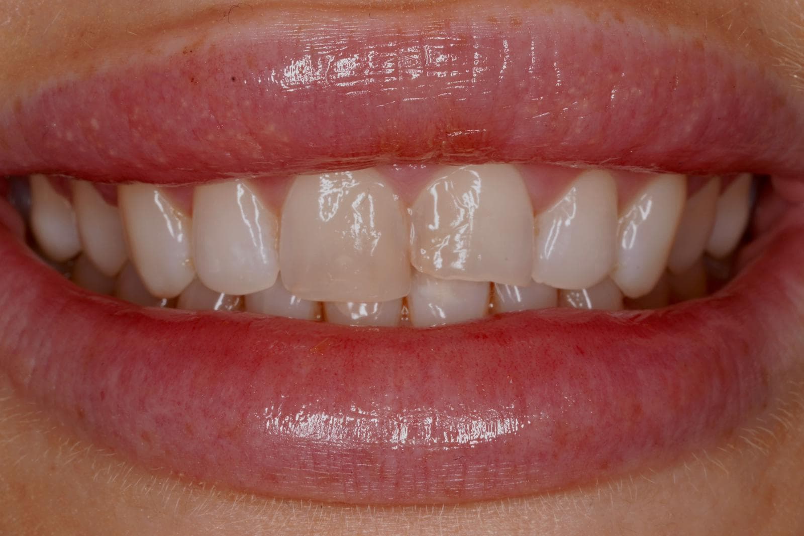 Emergency Chipped Tooth Repair — before