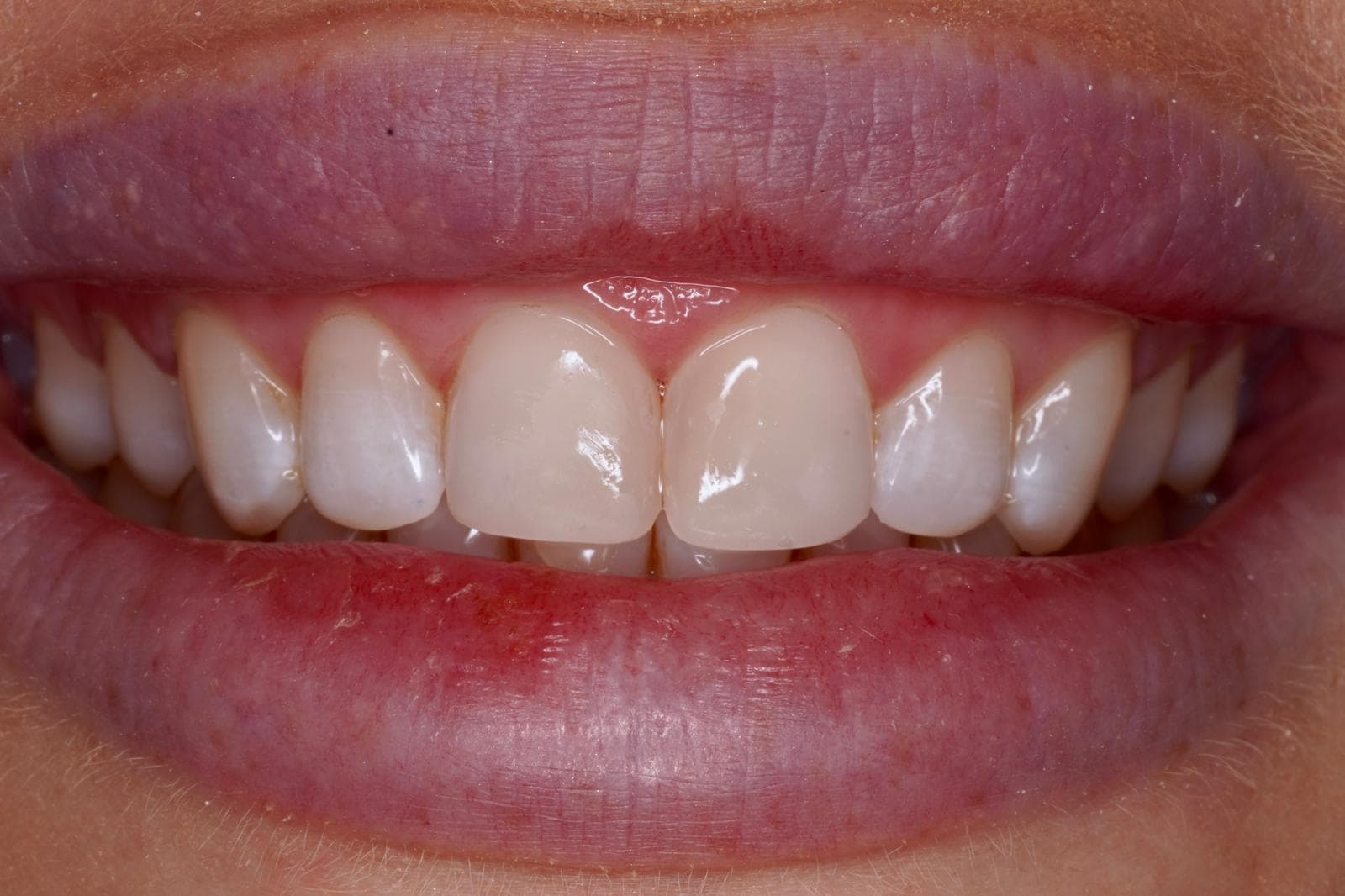 Emergency Chipped Tooth Repair — after