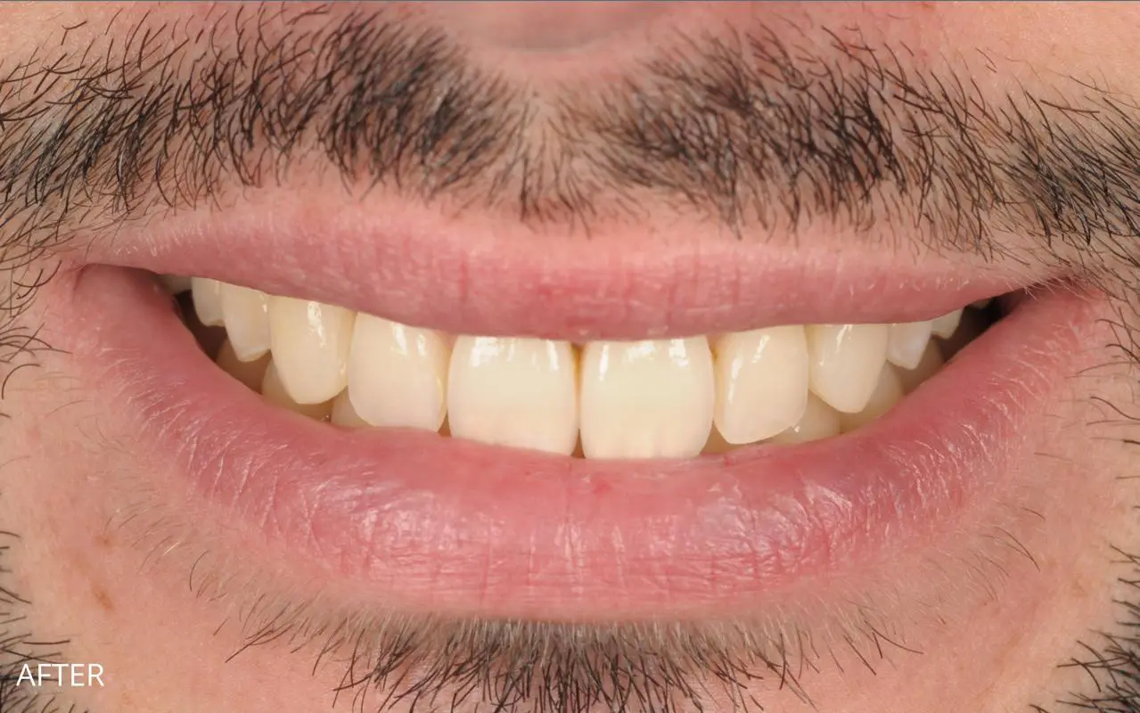 Full Veneer Smile Makeover — after