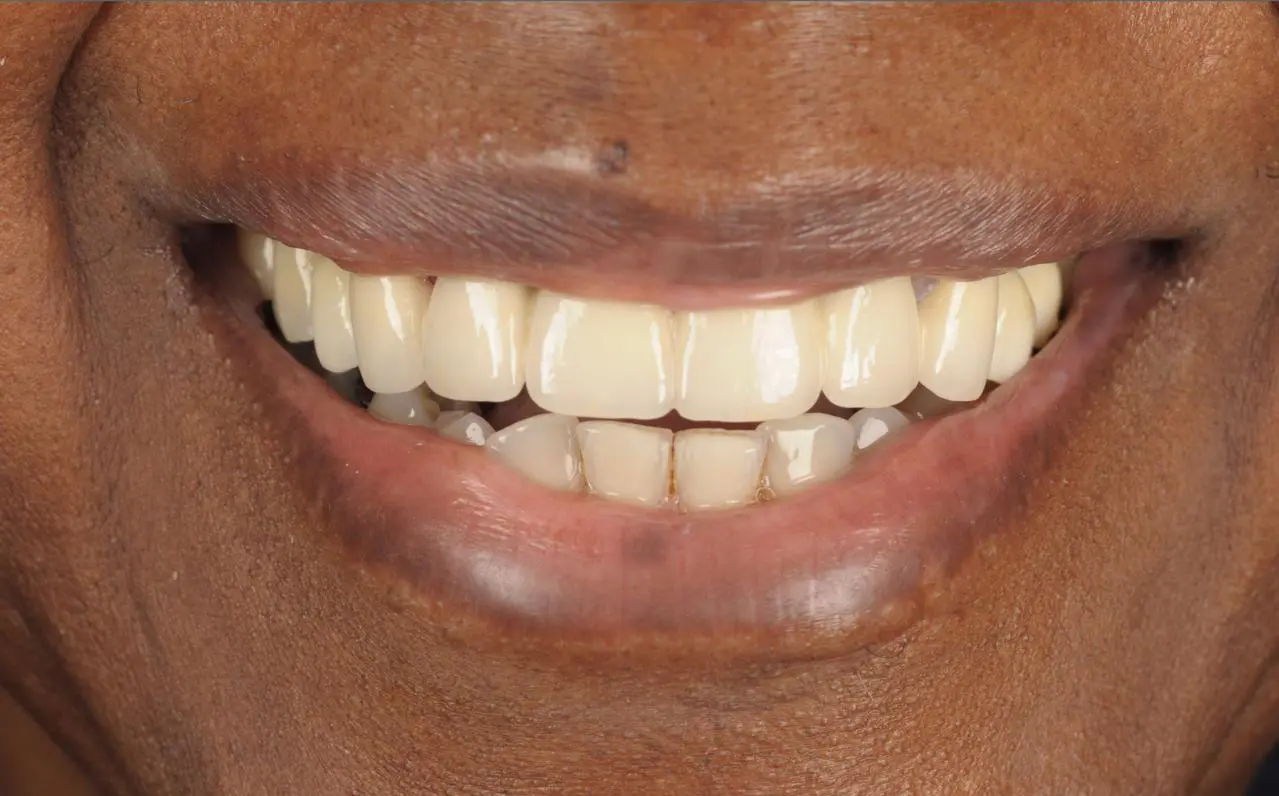 Missing Teeth Restored with Dental Implants — after