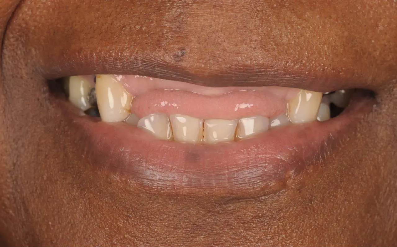 Missing Teeth Restored with Dental Implants — before