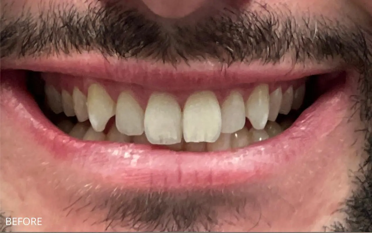 Full Veneer Smile Makeover — before