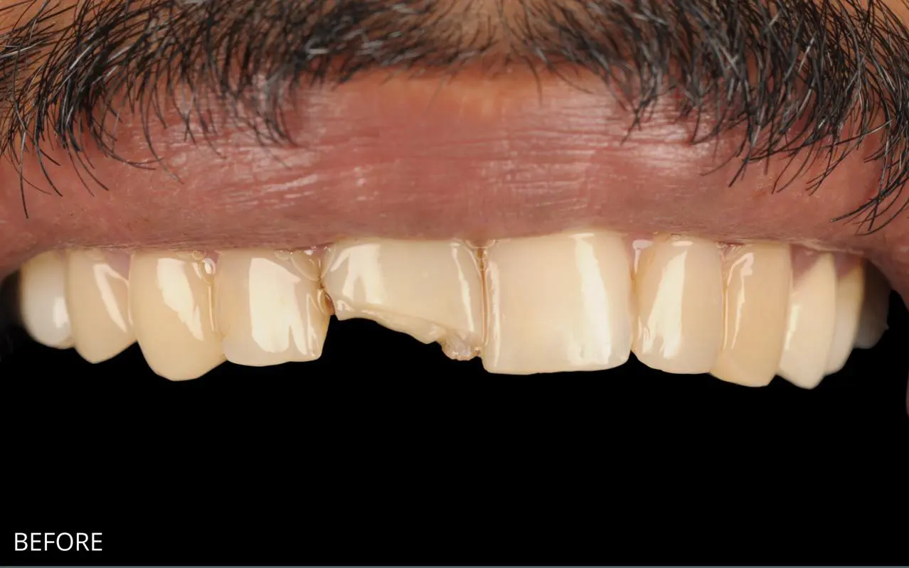 Before Front Teeth Composite Bonding