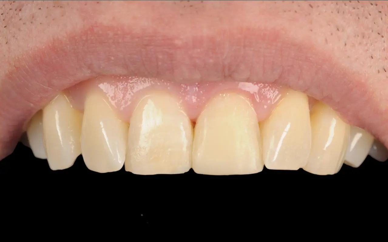 After Dental Composite Restoration