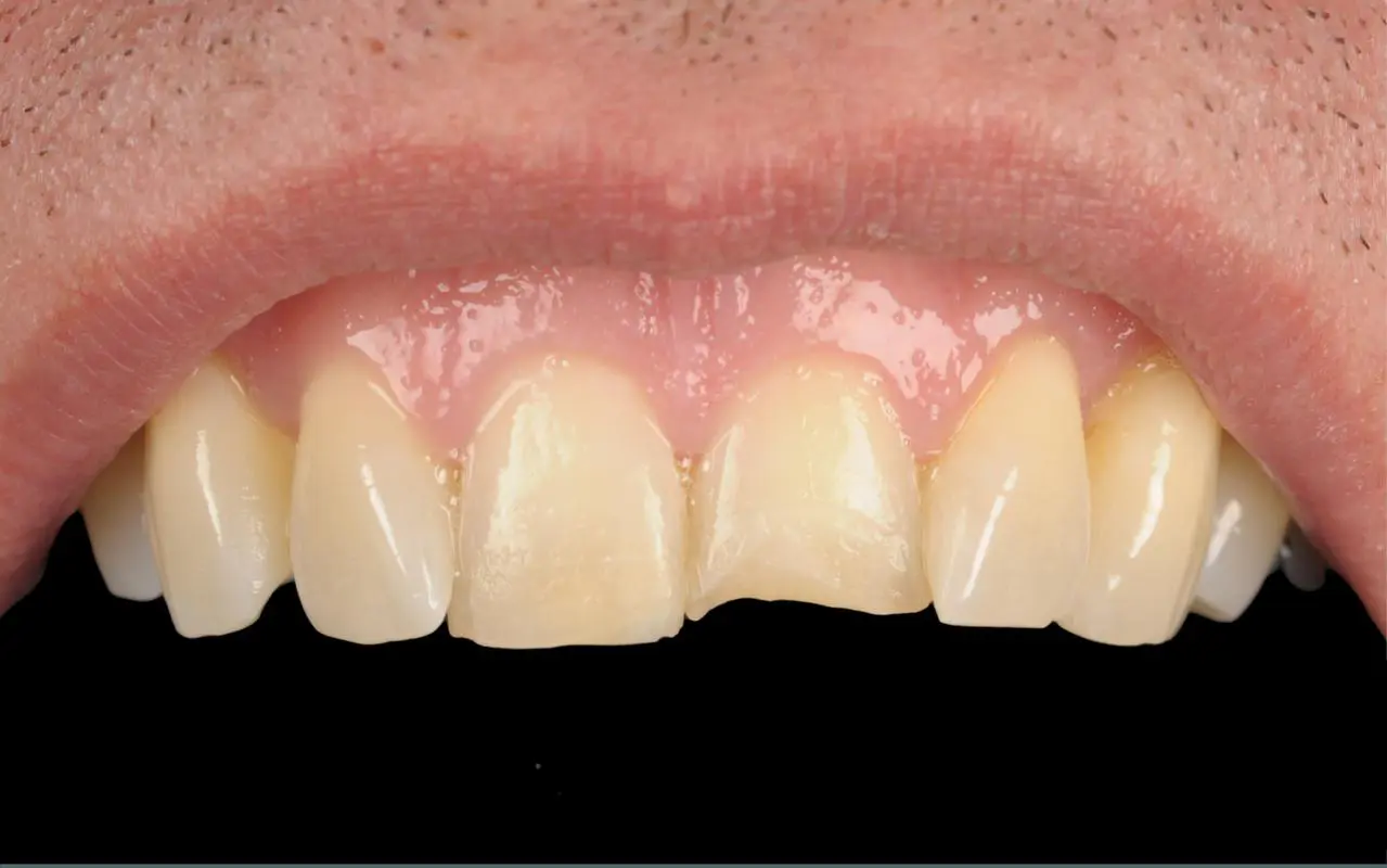 Before Dental Composite Restoration
