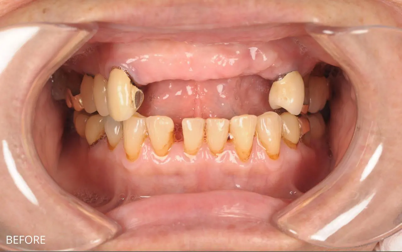 Implant-Supported Bridge — Front Teeth — before
