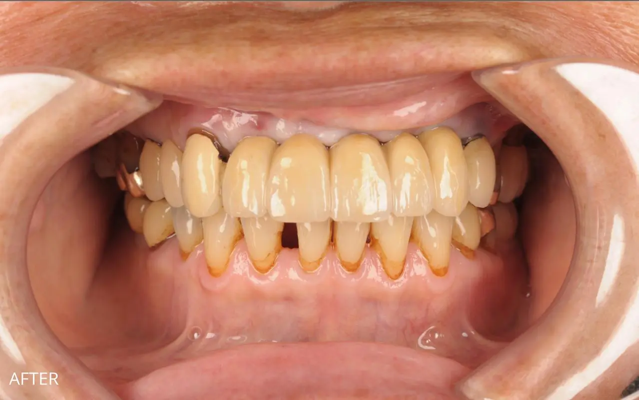 Implant-Supported Bridge — Front Teeth — after