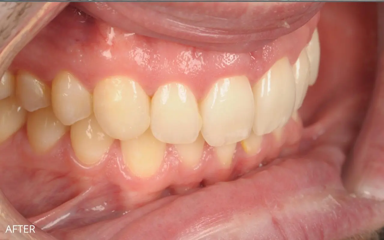 Invisible Braces, Bonding & Whitening — after