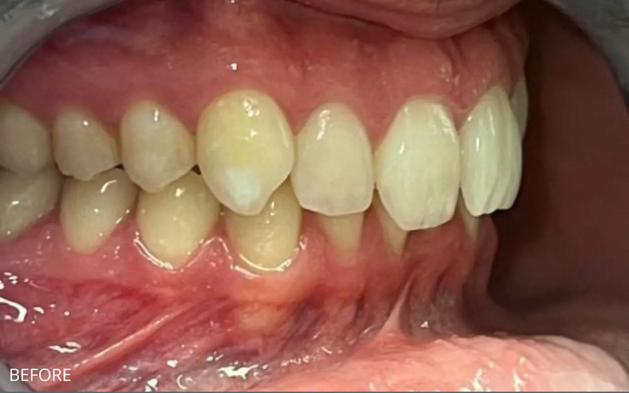 Invisible Braces, Bonding & Whitening — before