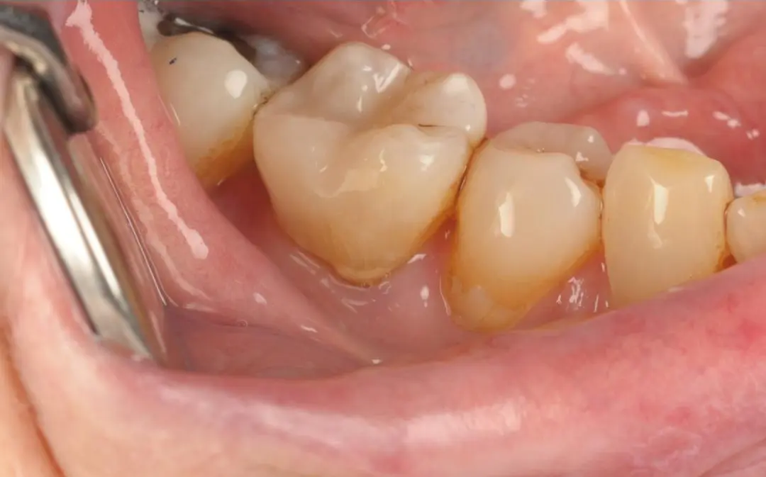 After Natural-Looking White Fillings
