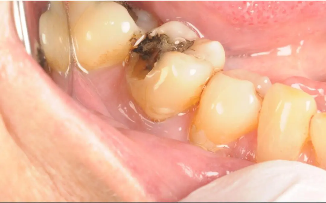 Before Natural-Looking White Fillings