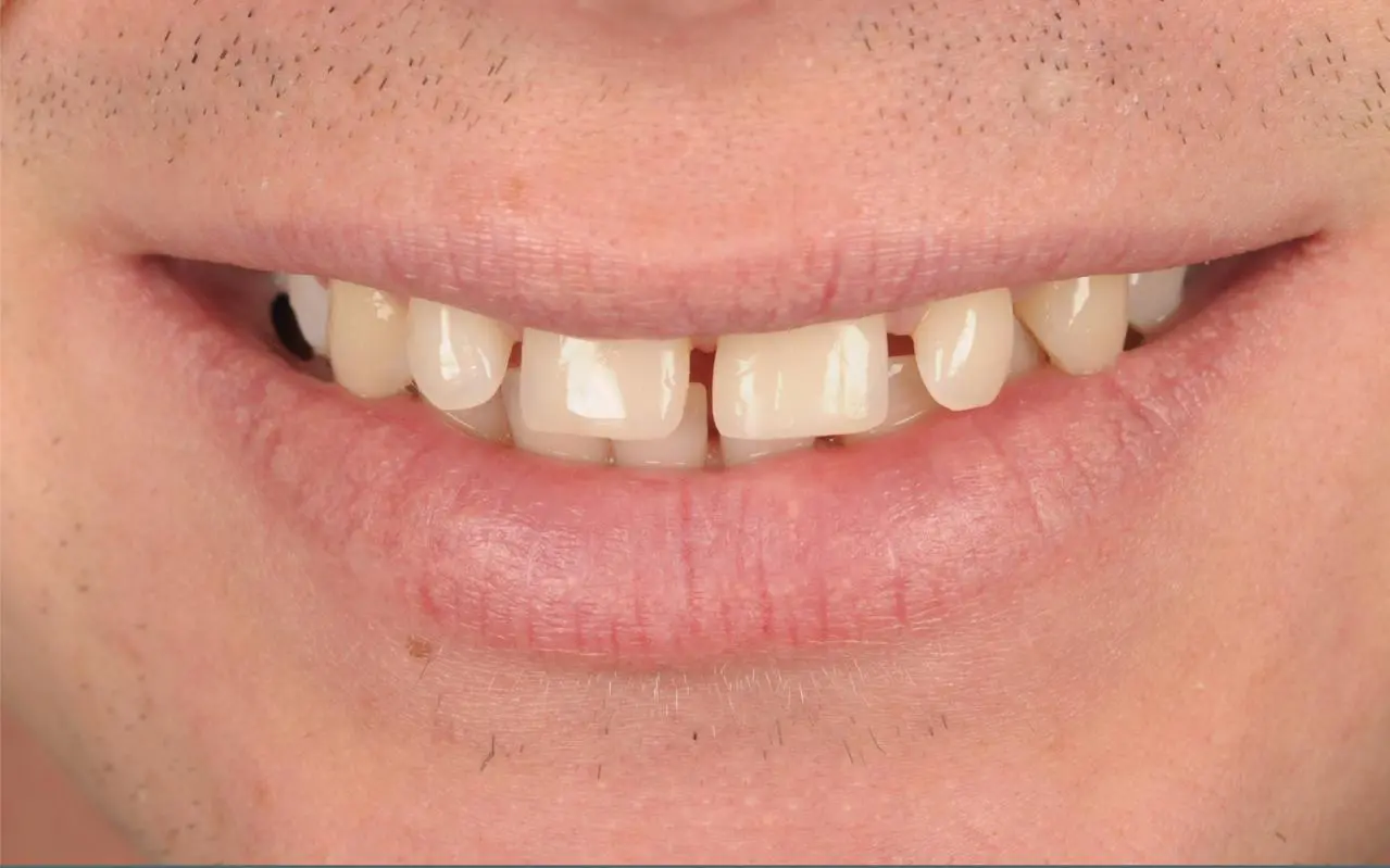 Gap Tooth Bonding — before