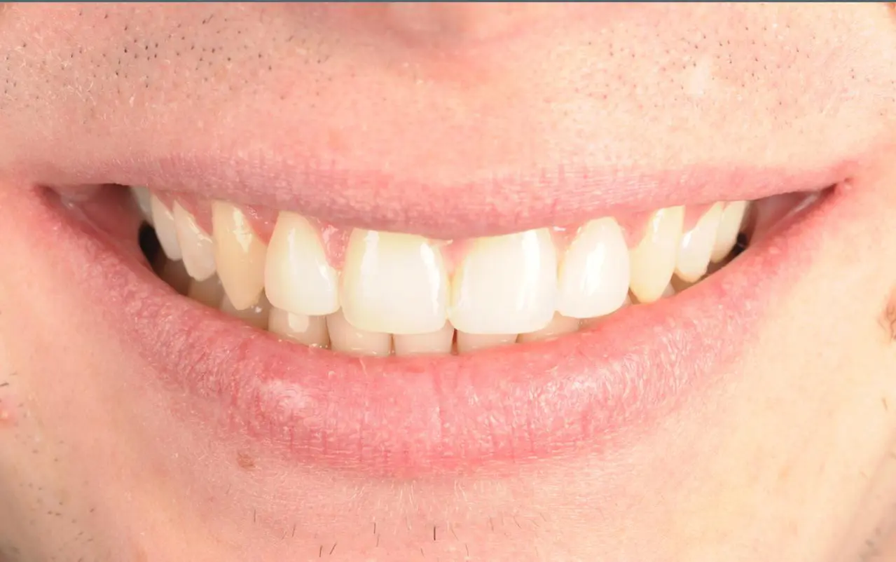 Gap Tooth Bonding — after