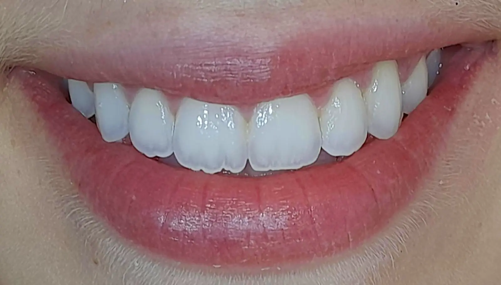 Edge Bonding — Minimal Refinement — before