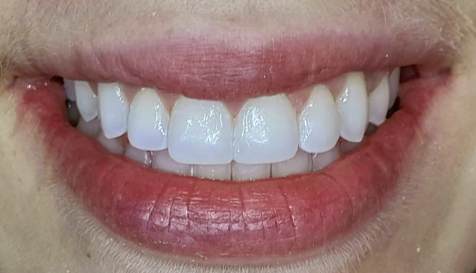 Edge Bonding — Minimal Refinement — after