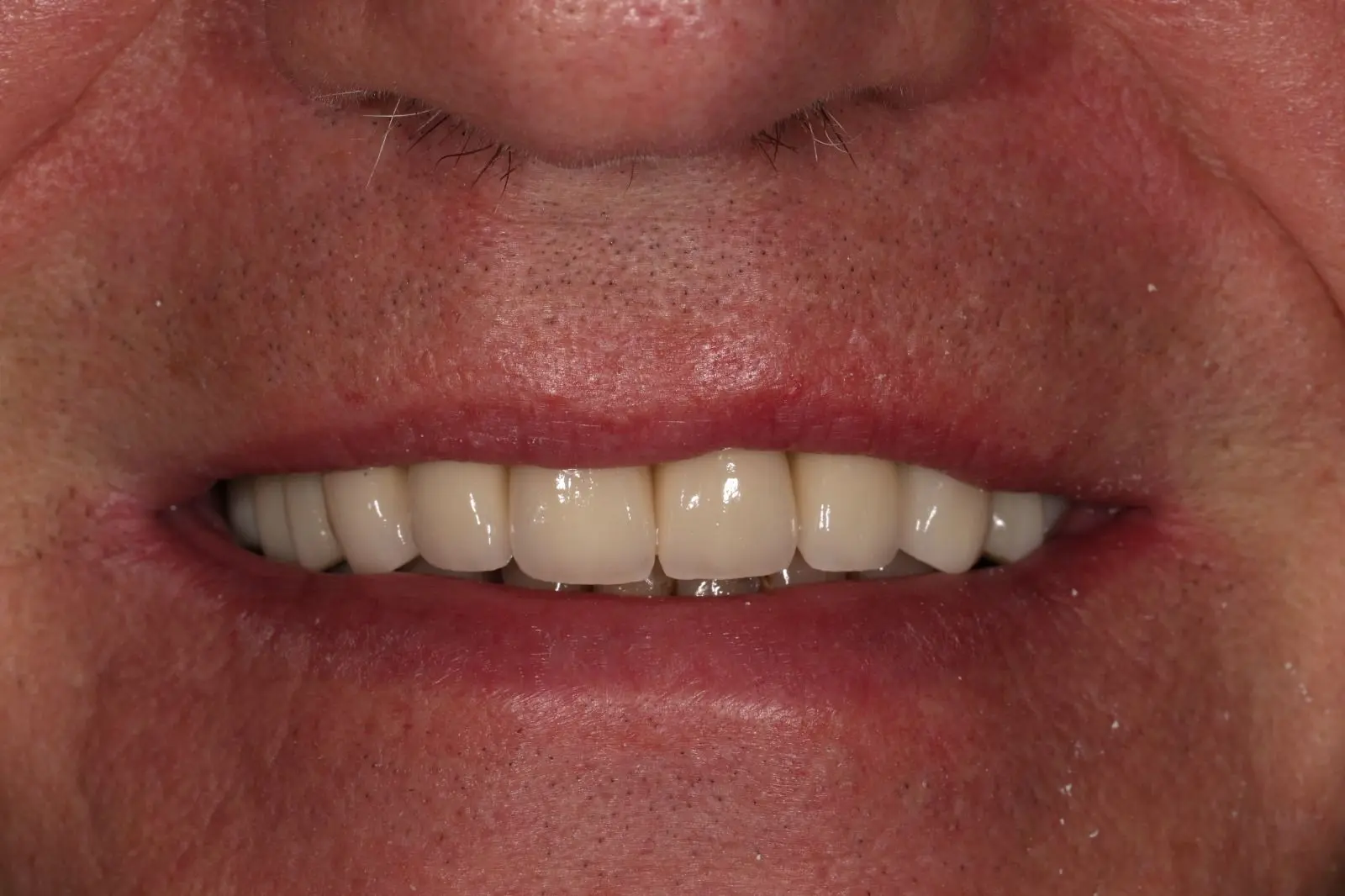 After Full Mouth Rehabilitation