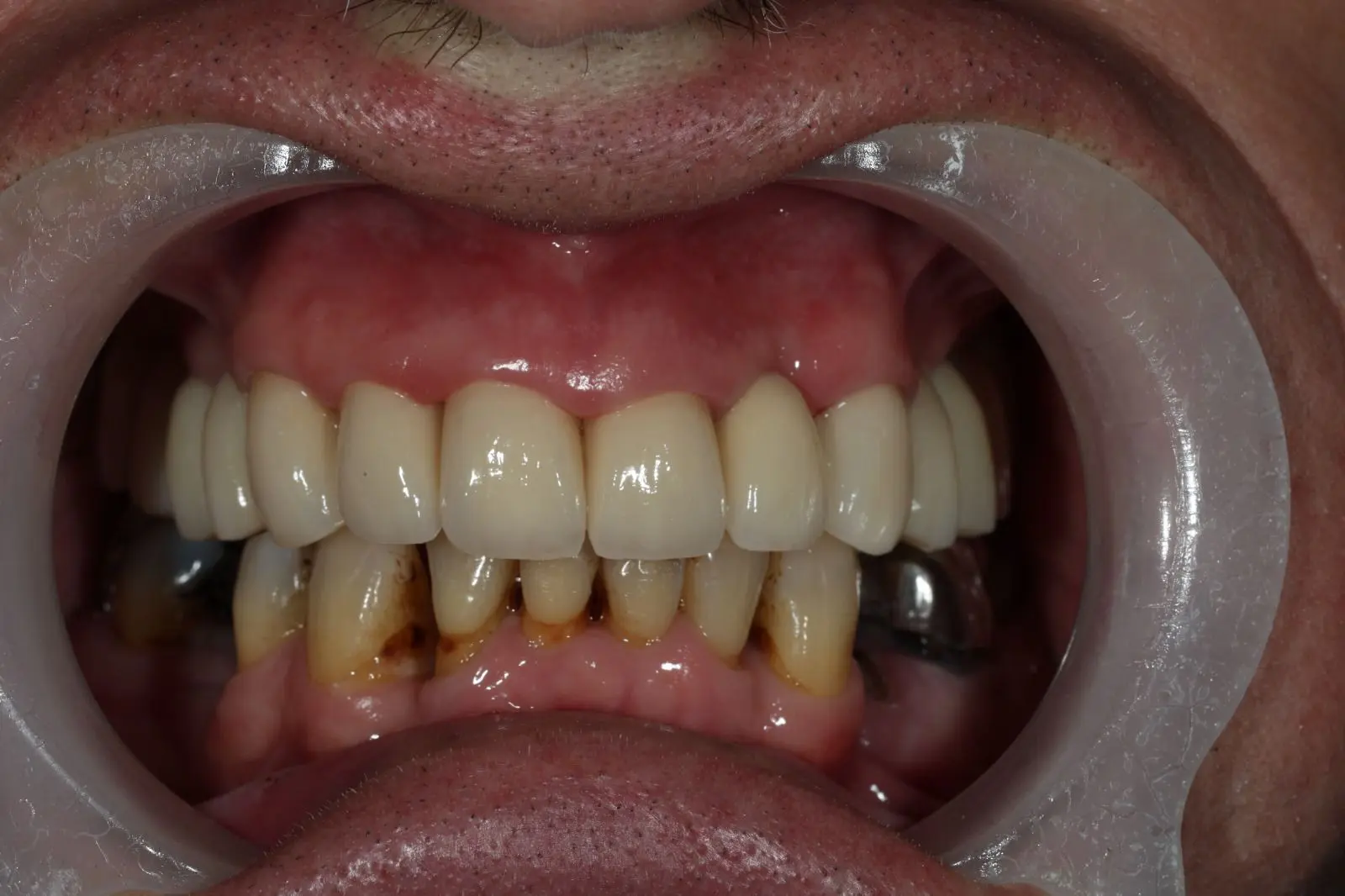 After Comprehensive Full Mouth Restoration