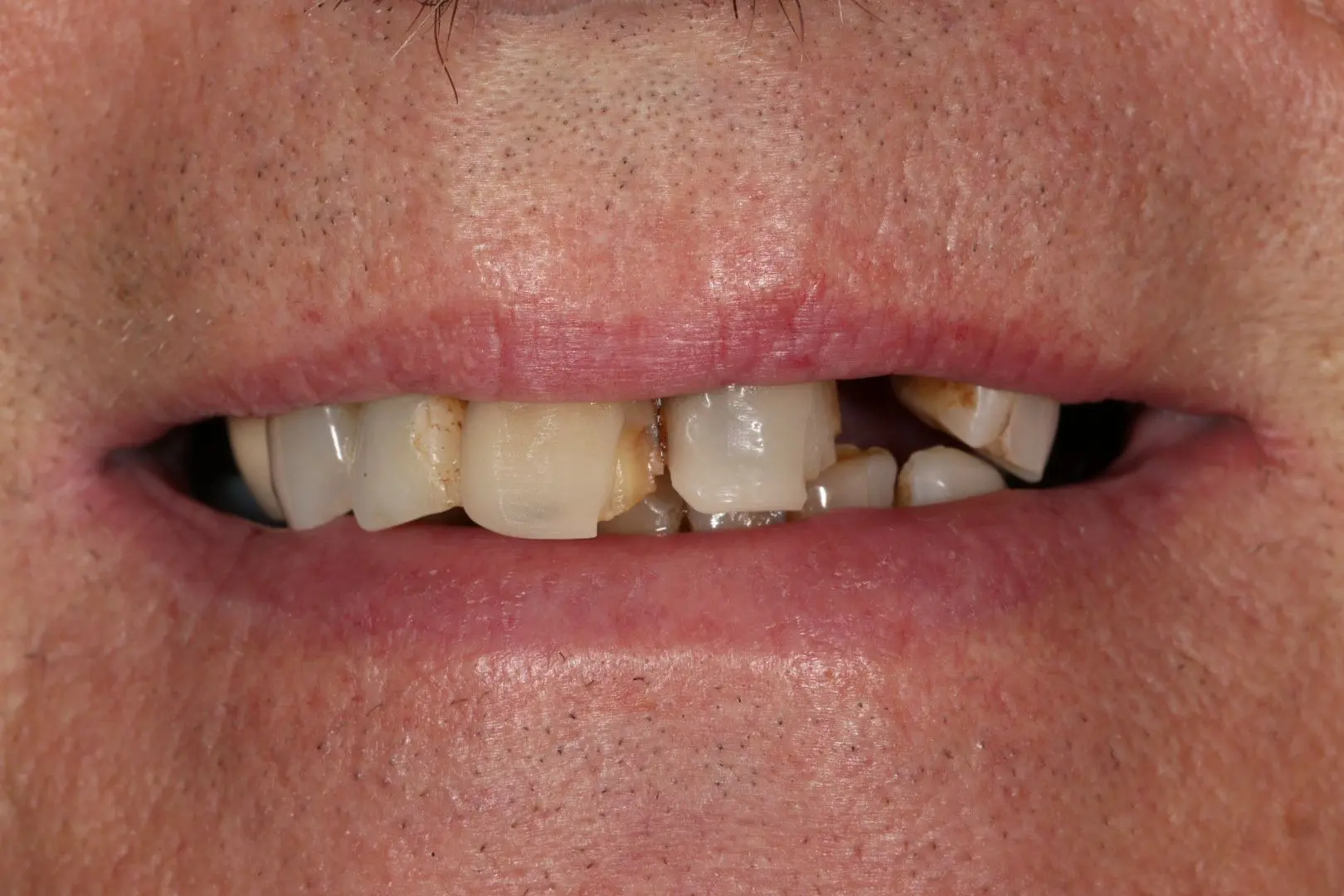 Before Full Mouth Rehabilitation