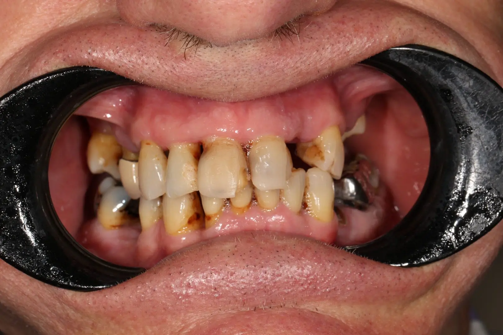 Before Comprehensive Full Mouth Restoration