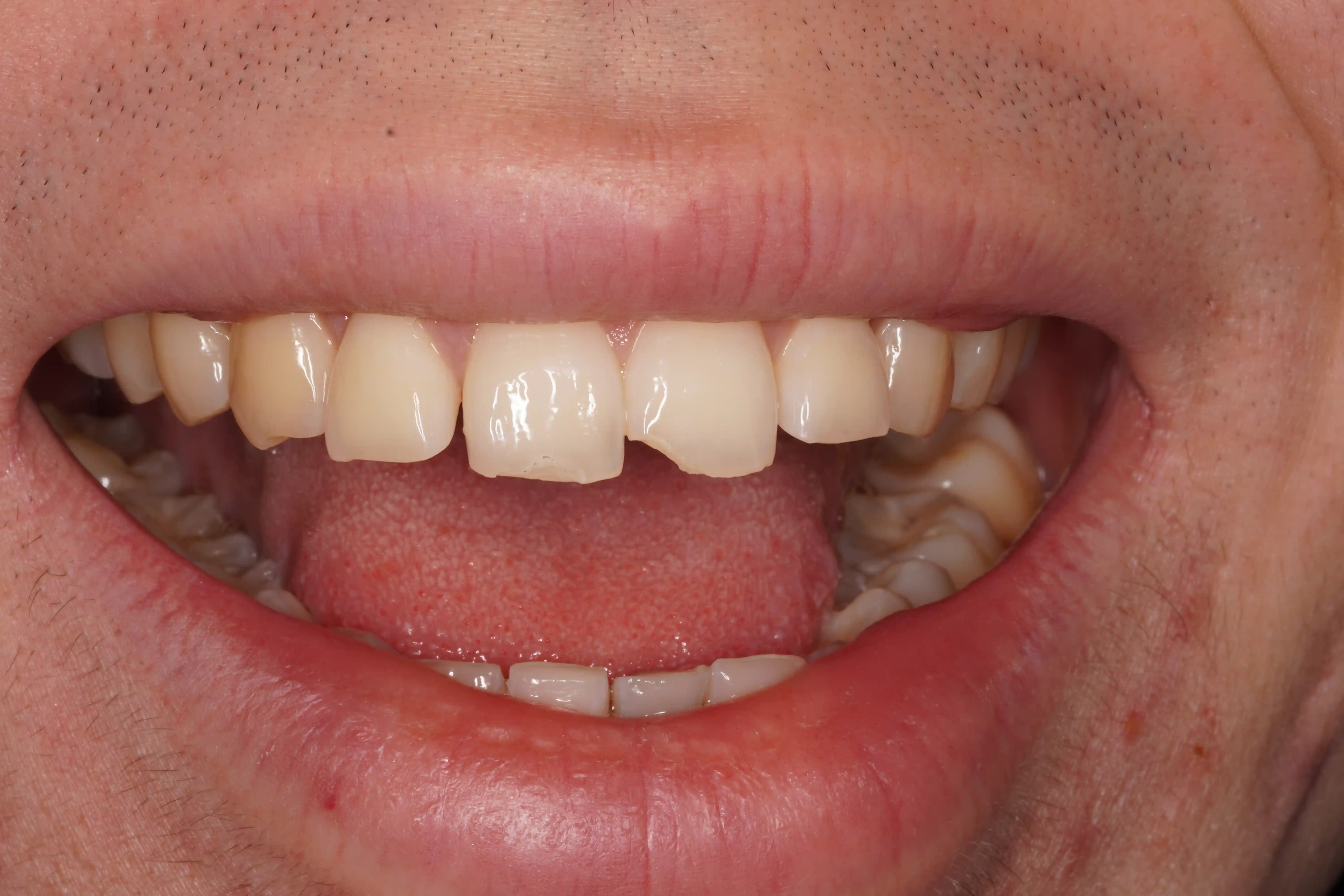 Before Chipped Front Tooth — Seamless Repair