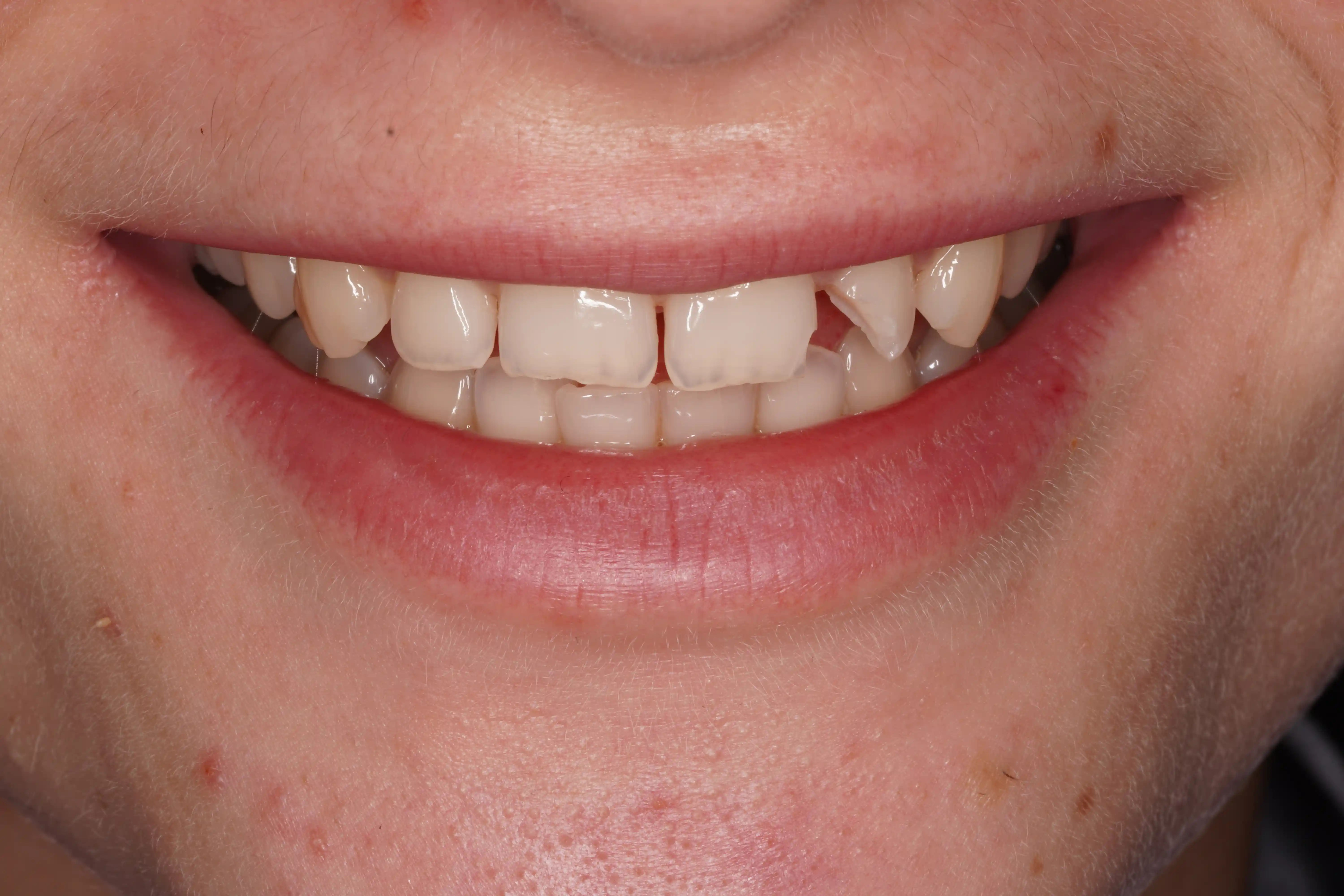 Before Fractured Canine & Front Tooth Repair