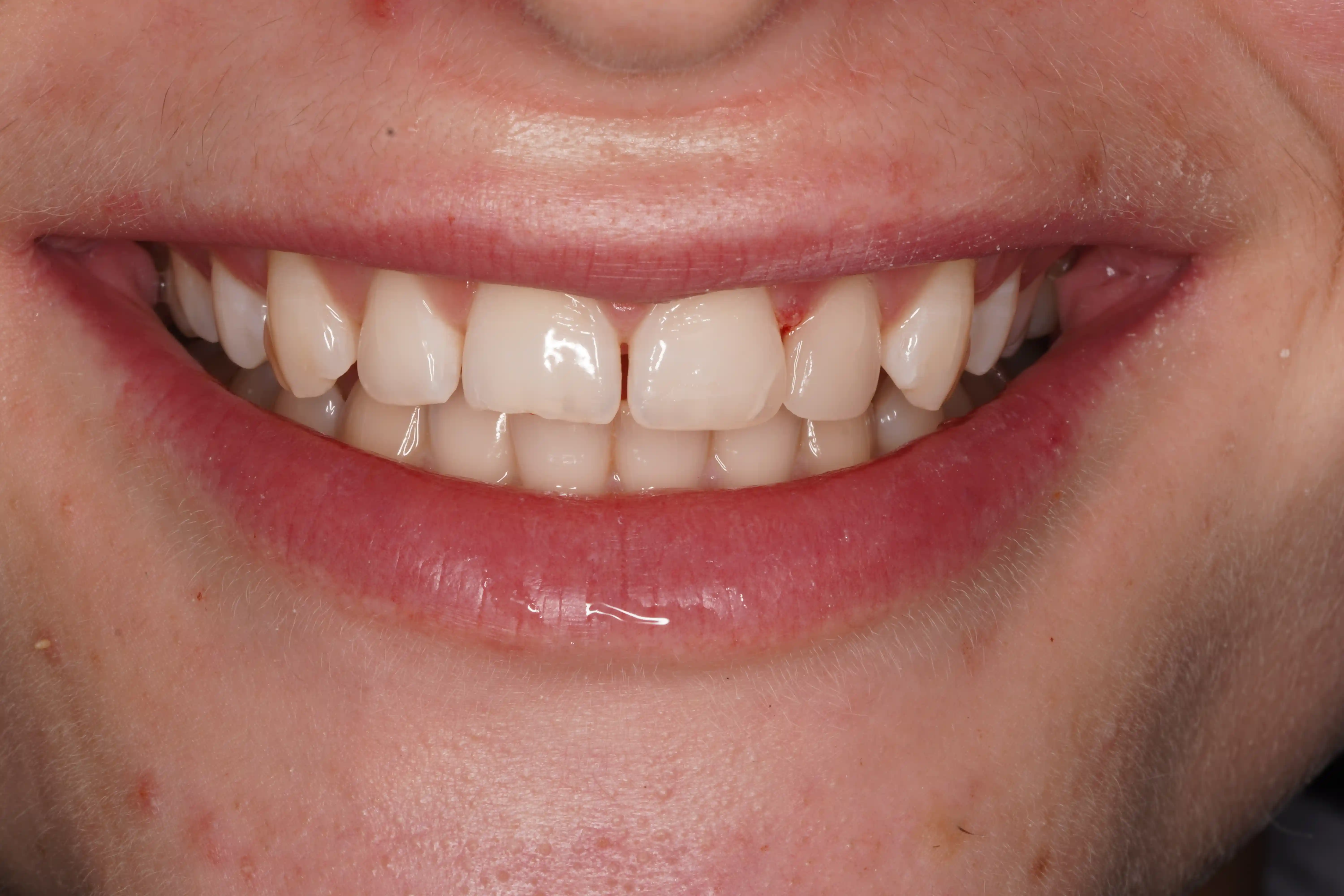 After Fractured Canine & Front Tooth Repair