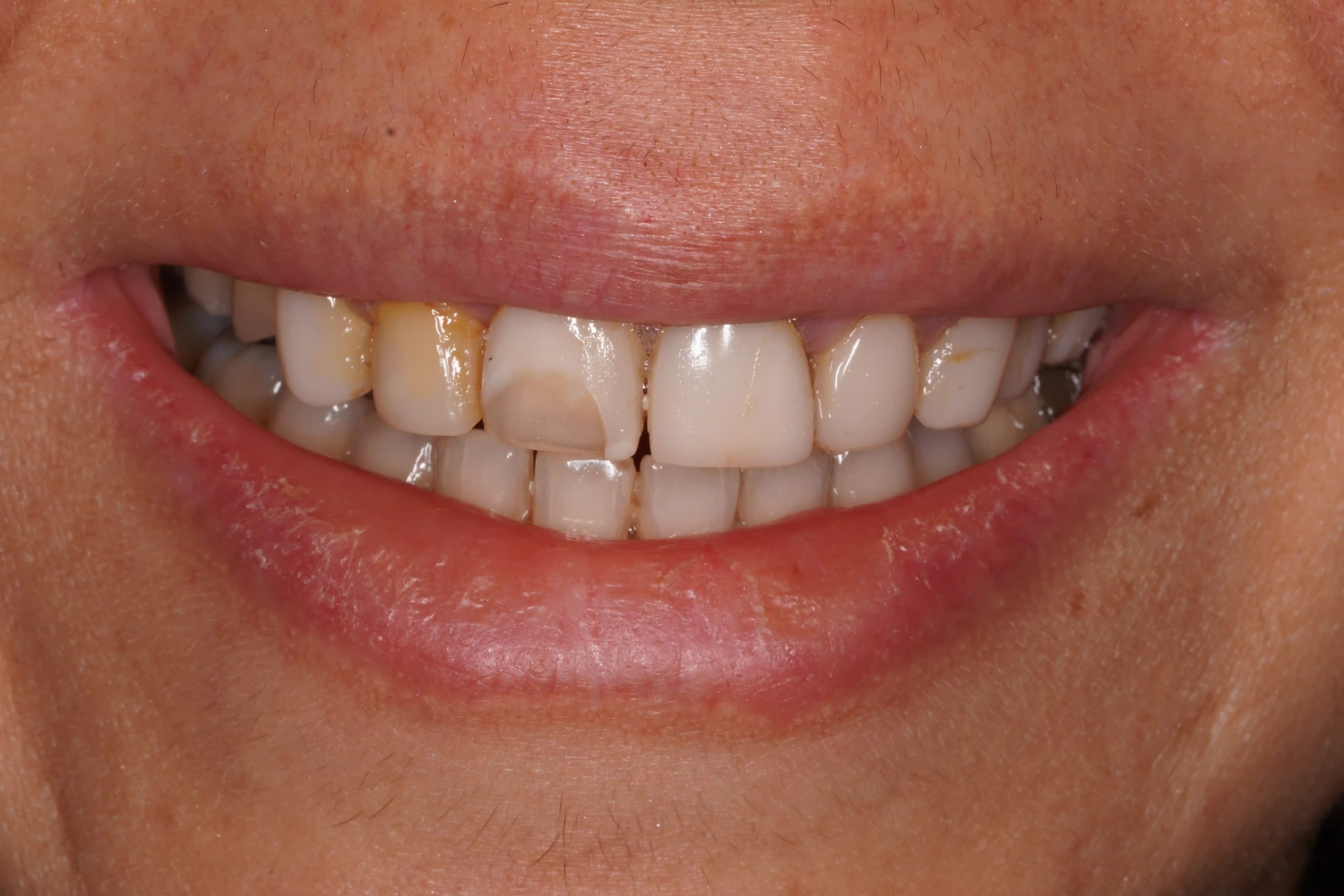 Before Chipped Front Tooth Repaired