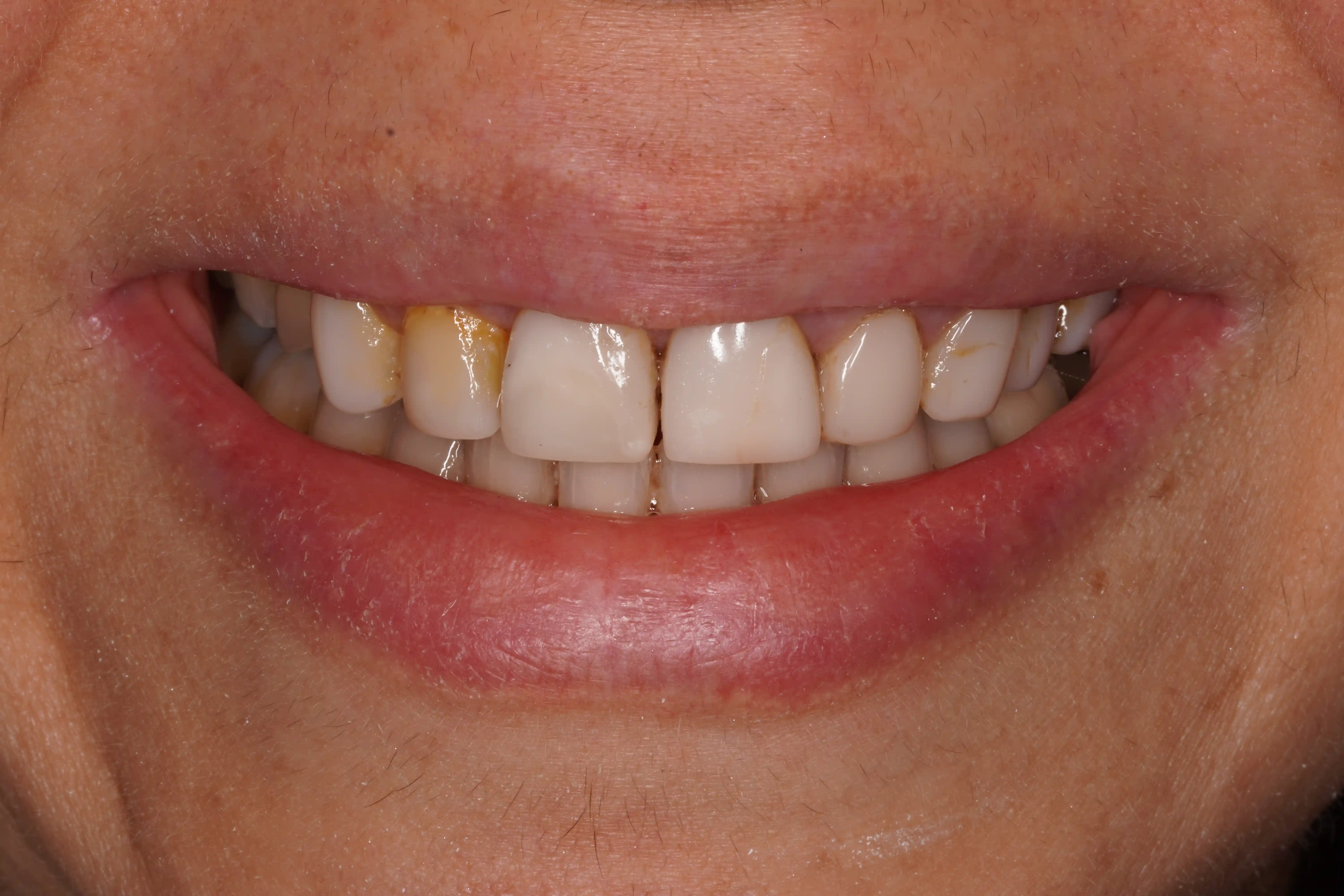 After Chipped Front Tooth Repaired