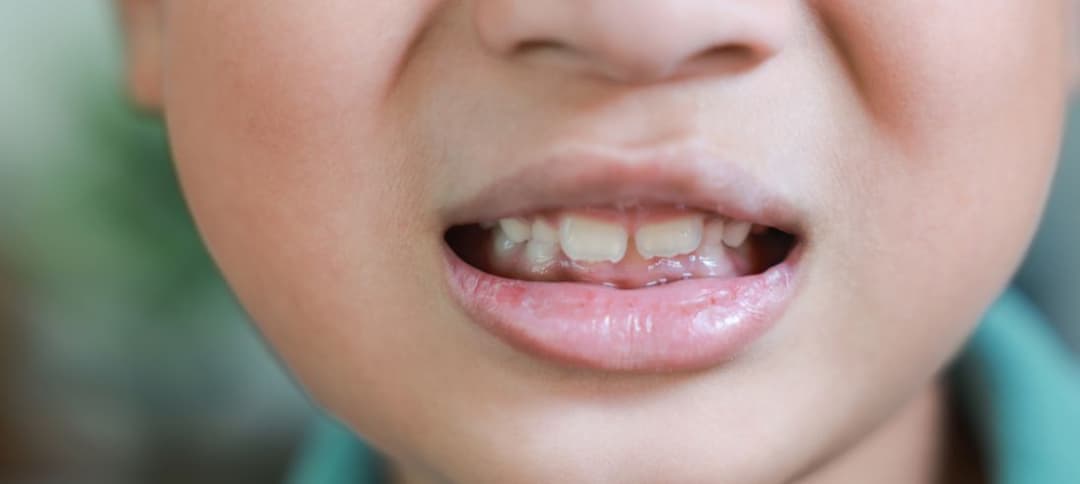 Oral Hygiene Tips for Teenagers with Braces