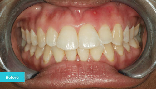 Invisalign Contouring Before 1