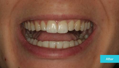 Invisalign Case After 1