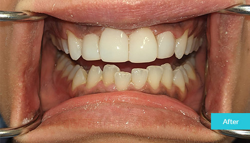Teeth whitening & bonding after 1