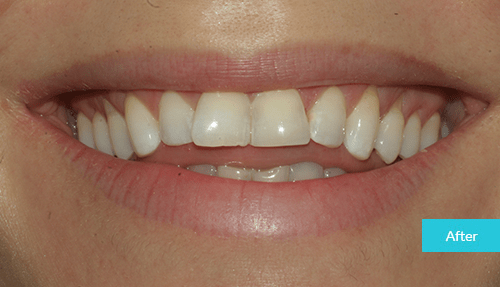 Teeth whitening & bonding after 2