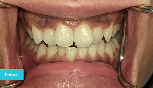 Teeth whitening & bonding before 1