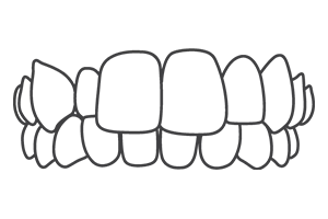 Crossbite – Dental Clinic